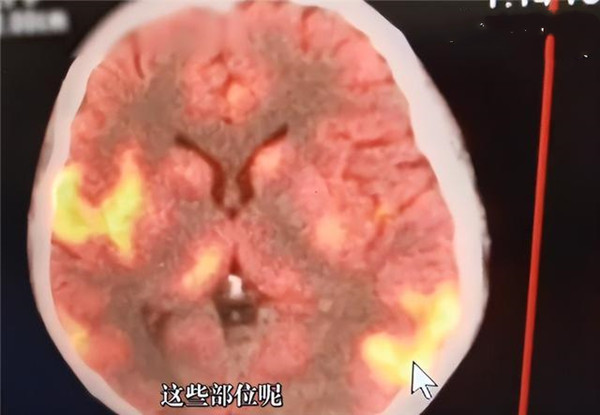 女网友发烧一周致昏迷，医生：脑部像燃起了熊熊大火！